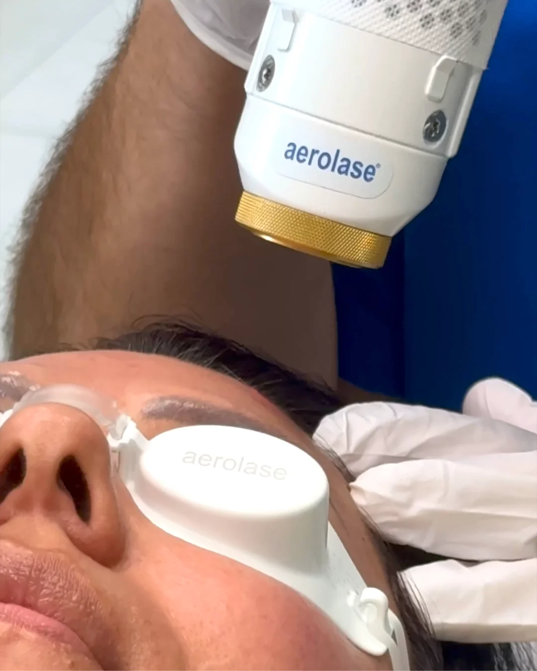Clinician using a handheld laser device on a patient wearing protective eyewear